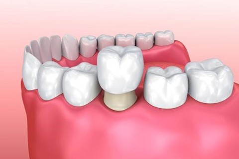 FIXED PROSTHODONTICS - hiDental Clinic