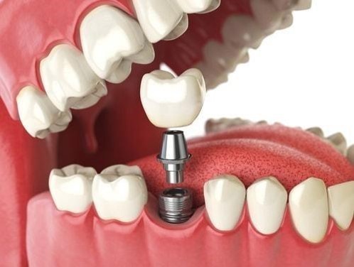 cấy ghép implant