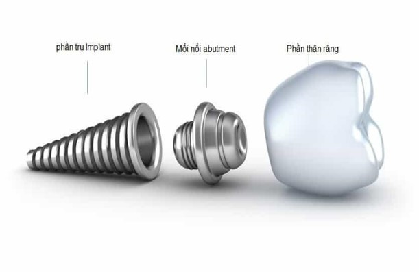 cấy ghép implant