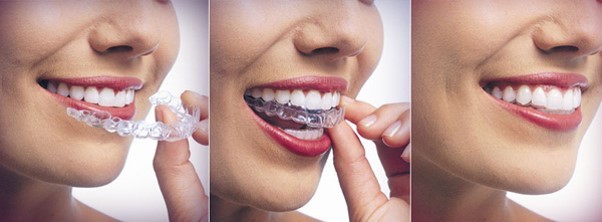 niềng răng invisalign