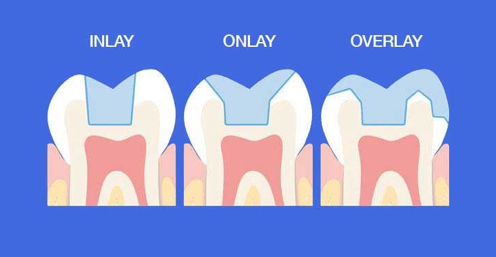 Виды вкладок. Вкладки Инлей онлей оверлей пинлей. Препарирование зуба под вкладку Inlay onlay и Overlay. Оверлей вкладка препарирование.