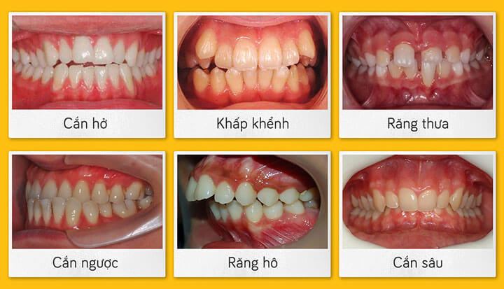 Niềng răng trong suốt Invisalign - Các vấn đề răng thưa hô khập khiễng cần phải niềng răng - Nha khoa hiDental