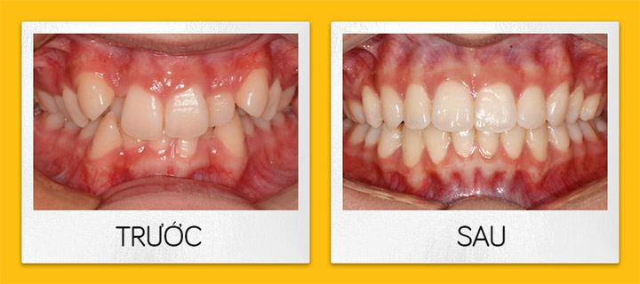 Niềng răng trong suốt Invisalign - Các case điều trị niềng răng trong suốt Invisalign điển hình - Nha khoa hiDental