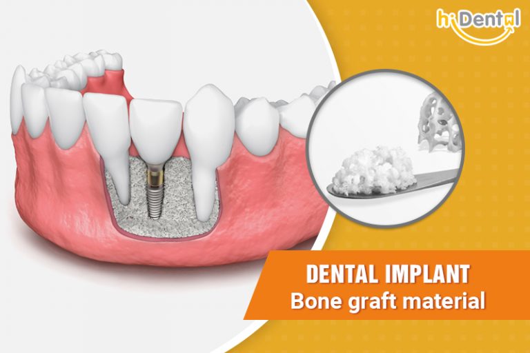DENTAL IMPLANT bone graft material hiDental Clinic