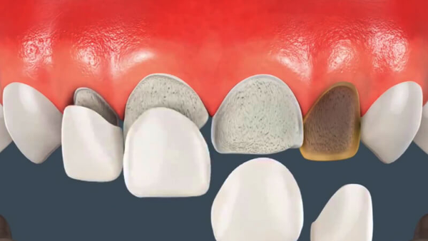 Các biến chứng sau khi bọc răng sứ có thể xảy ra