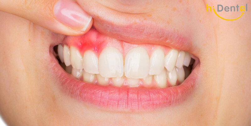 Bọc răng sứ bị viêm lợi