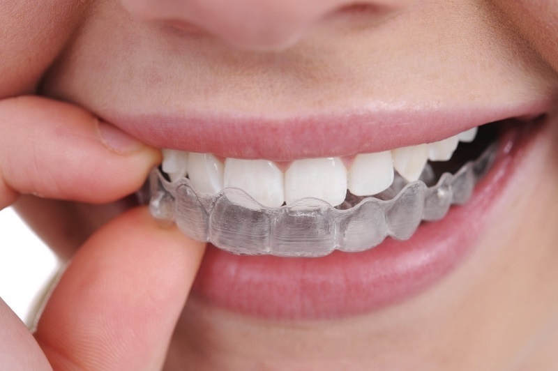 Cách sử dụng máng tẩy trắng răng