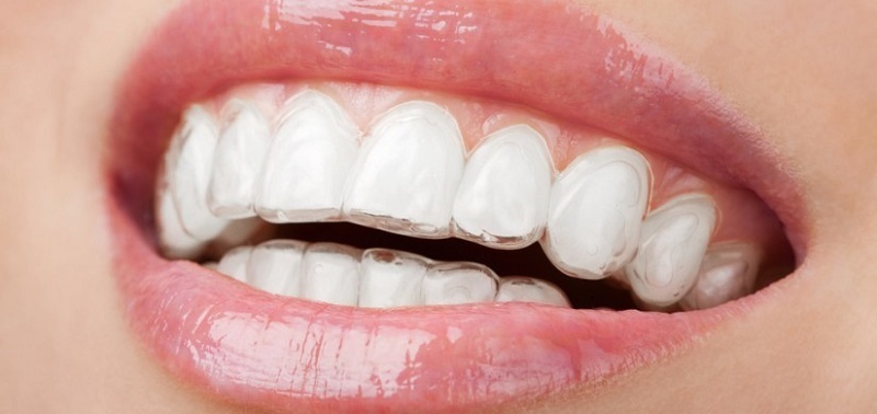 Cách sử dụng máng tẩy trắng răng an toàn và hiệu quả  hidental  nha khoa xin chào