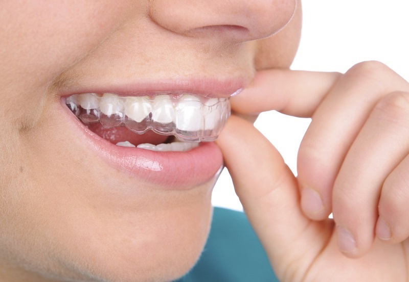 Cách sử dụng máng tẩy trắng răng