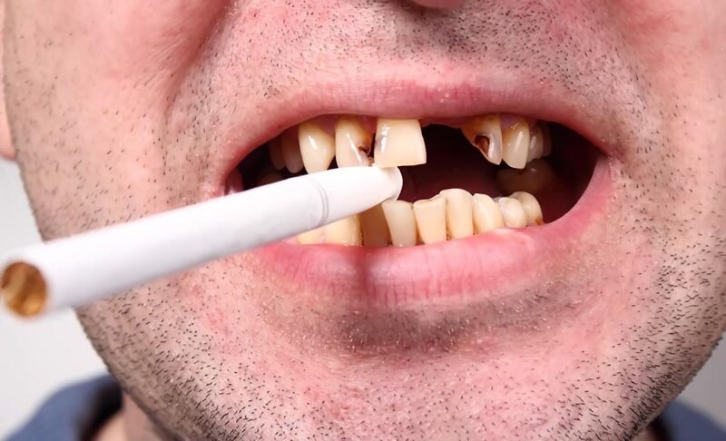 phương pháp tẩy trắng răng
