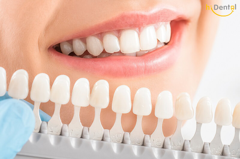 Tẩy trắng răng được bao lâu