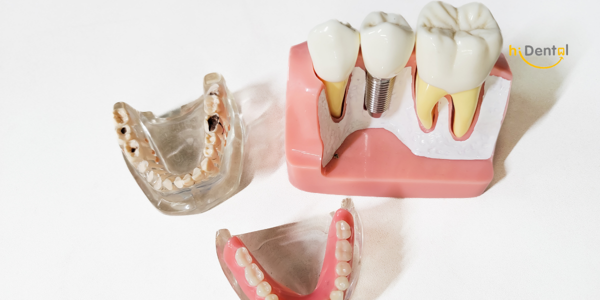 Lưu Ý Sau Khi Cấy Ghép Implant