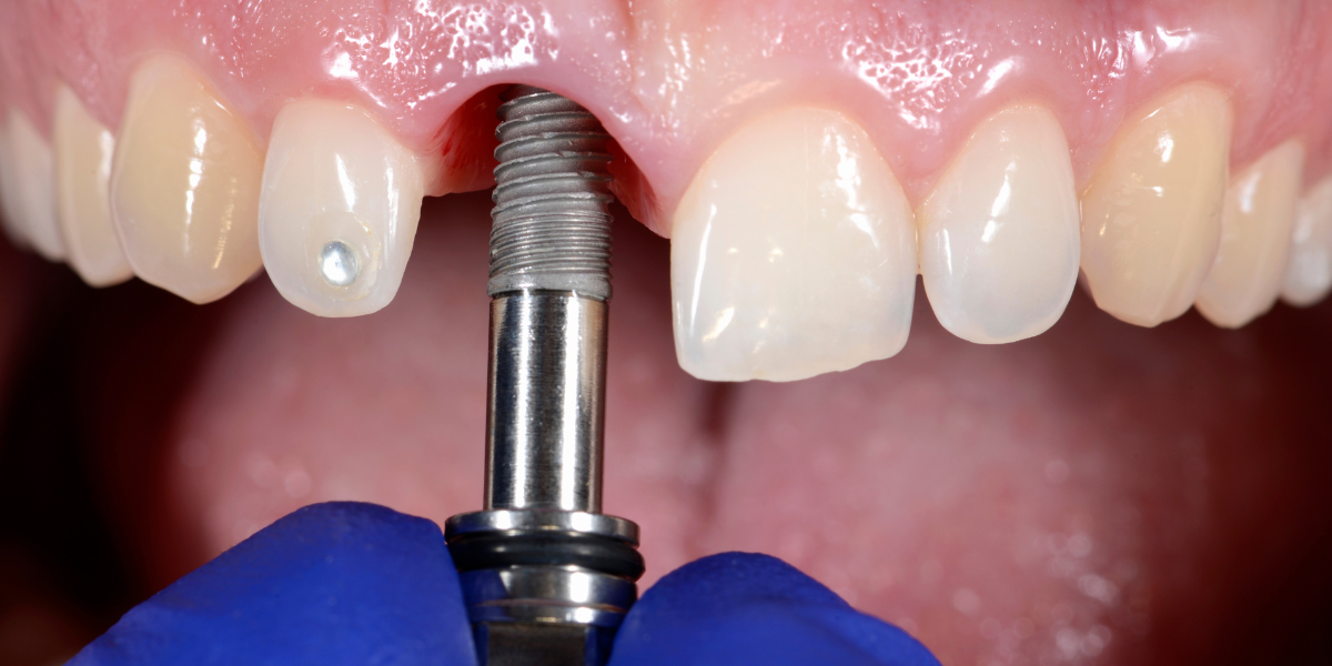 Địa Chỉ Cấy Ghép Implant Tốt