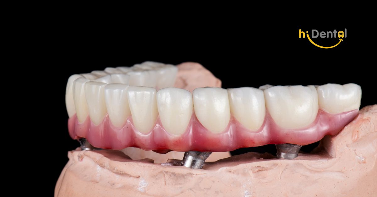 Nha Khoa Cấy Ghép Implant