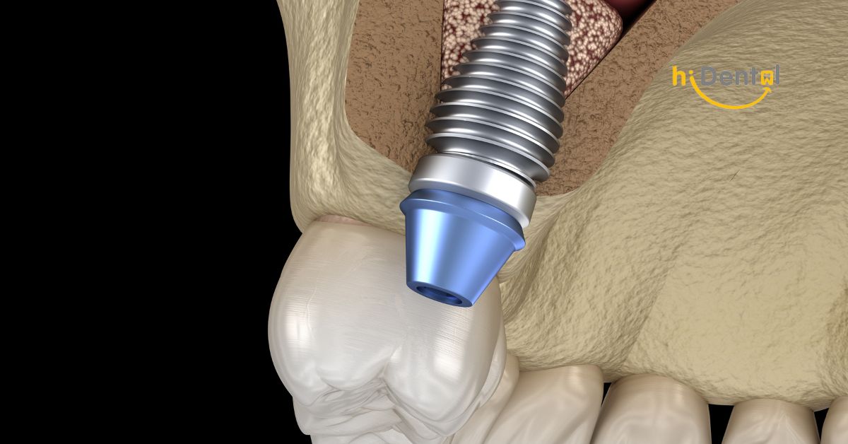 Nha Khoa Cấy Ghép Implant