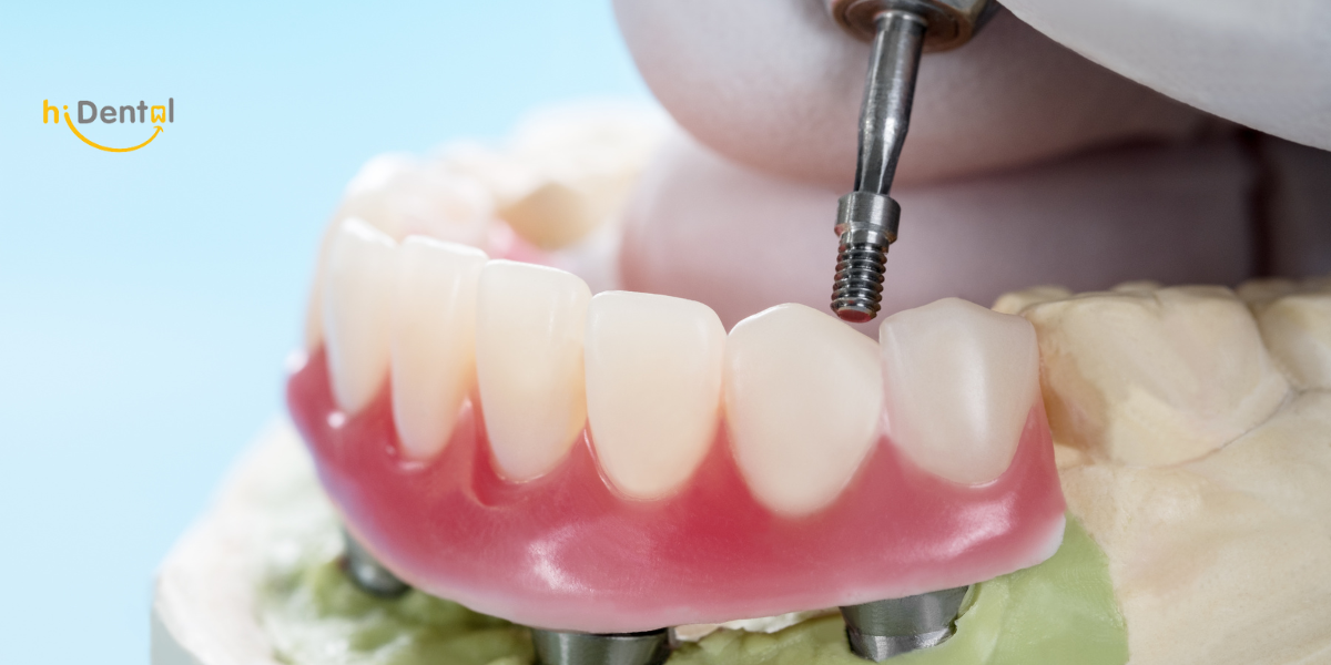 Cấy Ghép Implant Có Đau Không