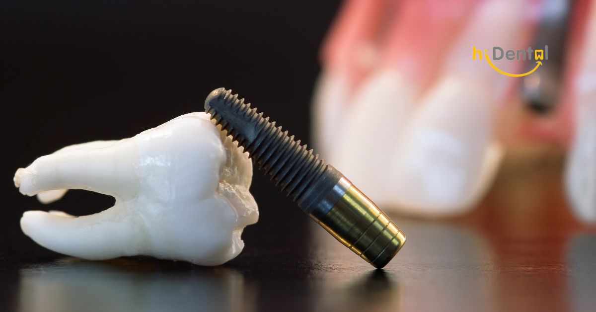 Nha Khoa Cấy Ghép Implant