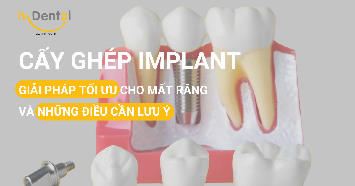 Cấy Ghép Implant Giải Pháp Tối Ưu Cho Răng Mất