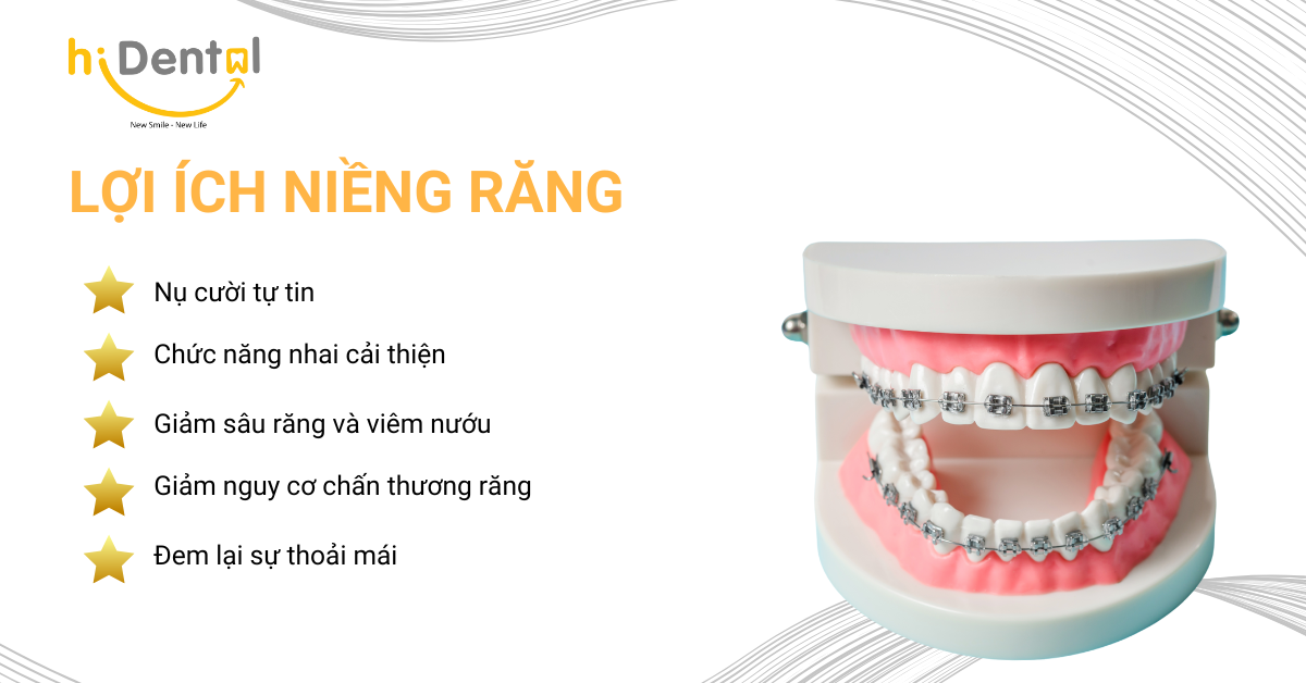 Niềng Răng Trả Góp