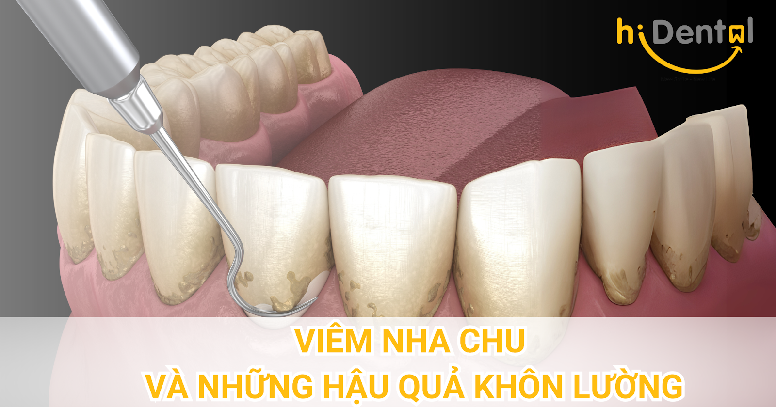 Viêm Nha Chu và Những Hậu Quả Khôn Lường