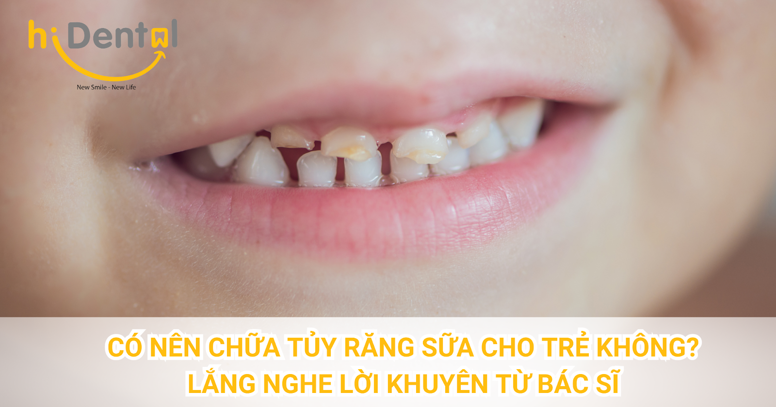 Có Nên Chữa Tủy Răng Sữa