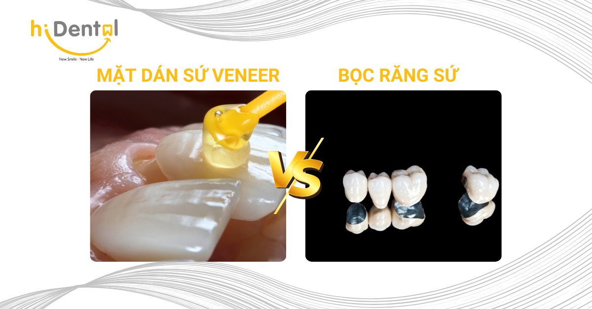 So Sánh Mặt Dán Sứ Và Bọc Răng Sứ