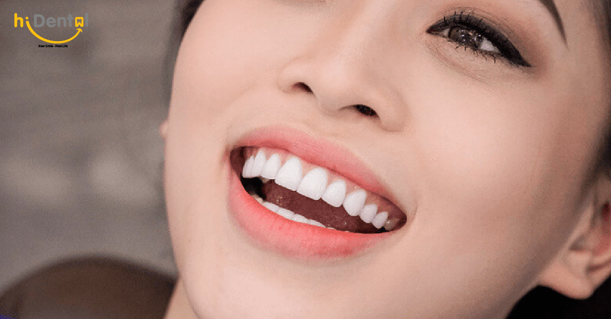Răng Toàn Sứ Và Răng Sứ Kim Loại