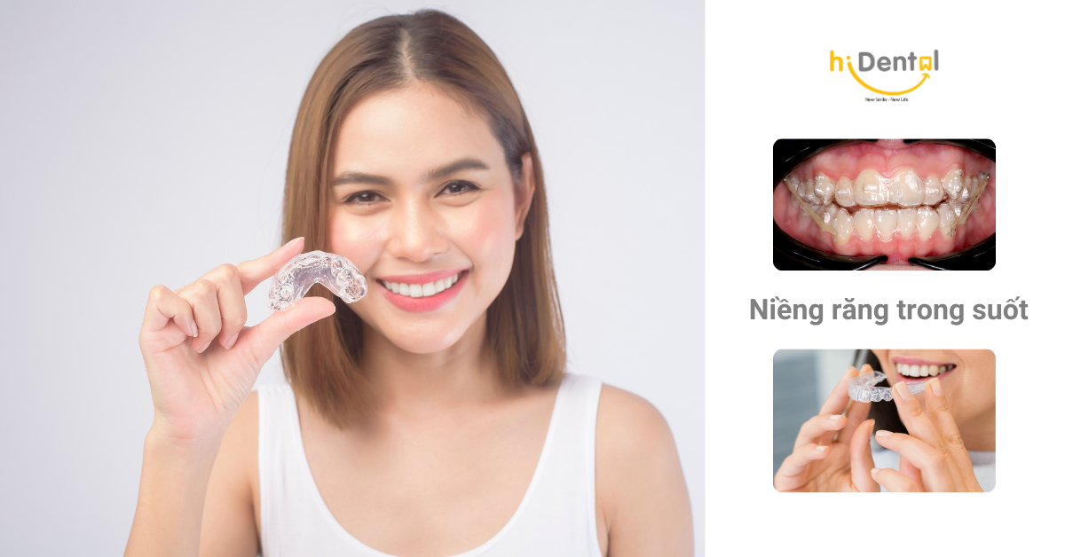 Giá niềng răng trong suốt bao nhiêu