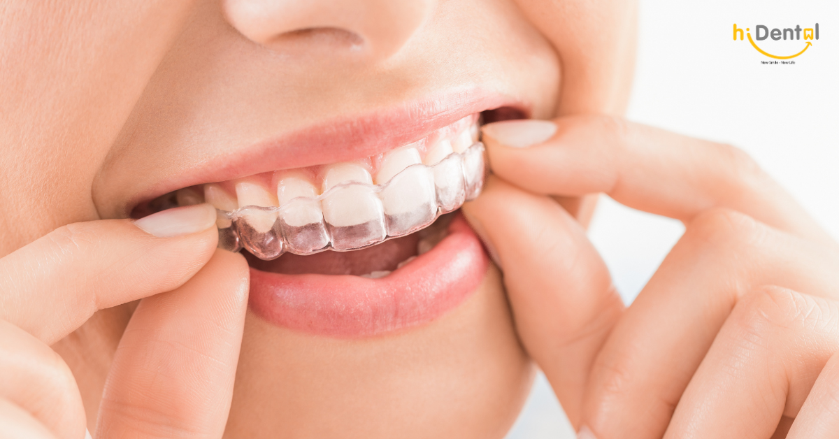 Niềng răng không mắc cài