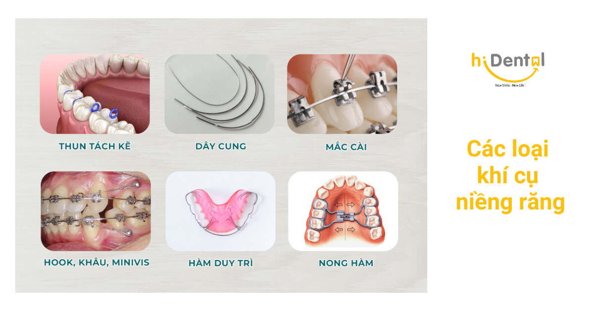 Niềng Răng Uy Tín