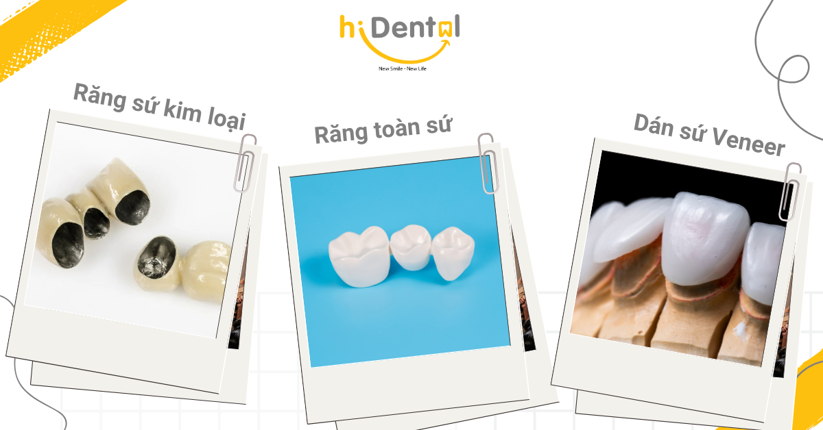 Có nhiều loại răng sứ để khách hàng lựa chọn