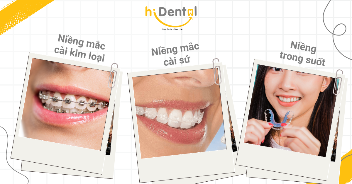 Các phương pháp niềng răng phổ biến