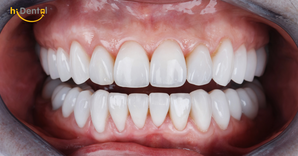 Công nghệ mới giúp thẩm mỹ răng sứ đơn giản, đẹp và nhanh gọn hơn cho khách hàng