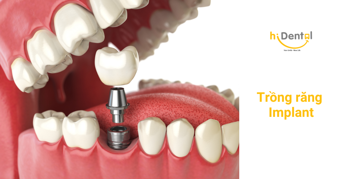 Trồng răng implant mang lại nhiều lợi ích cho khách hàng bị mất răng