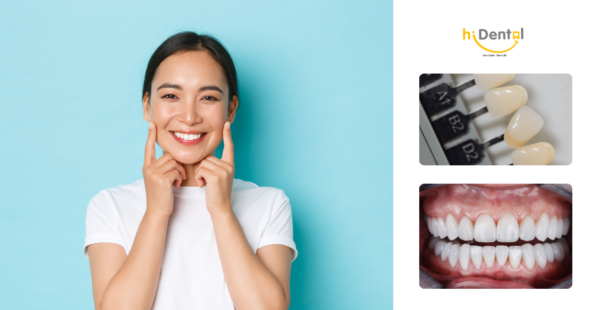 Những ai nên dán sứ veneer?