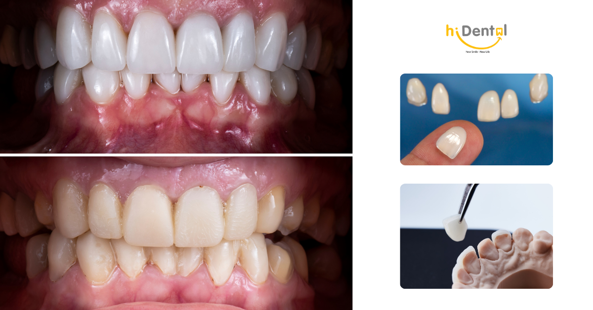 Dán sứ veneer mang lại nhiều lợi ích nhưng cũng có các nhược điểm
