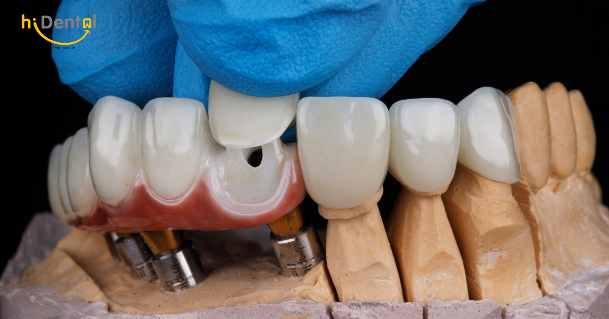 Quy trình làm răng sứ cần tuân thủ 5 bước chính