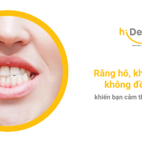 Răng hô khiến nhiều người mất tự tin