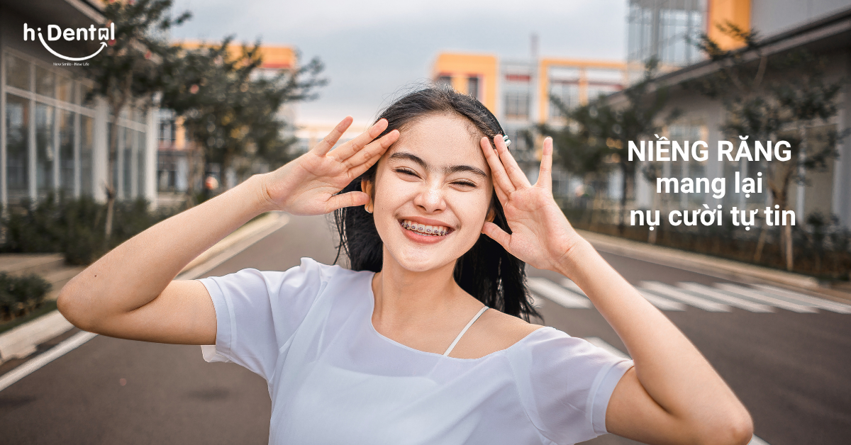 Niềng răng mắc cài là phương pháp thẩm mỹ được nhiều khách hàng lựa chọn