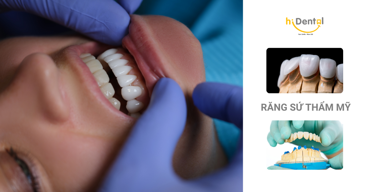 Thẩm mỹ răng sứ là dịch vụ nhiều khách hàng lựa chọn