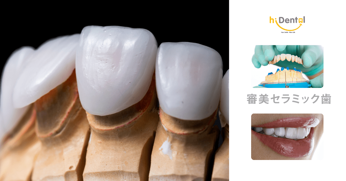 Chi phí bọc răng sứ phụ thuộc vào nhiều yếu tố